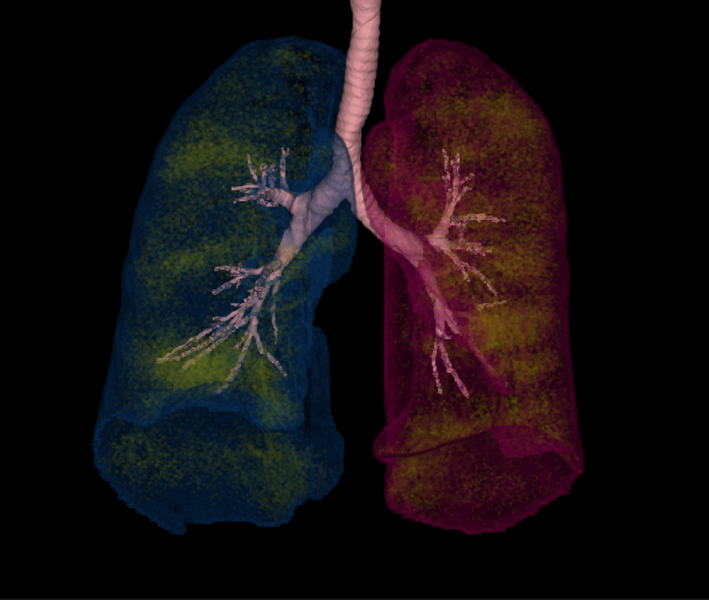 Advanced Clinical Workflows, Neuro, CT Respiratory Analysis.