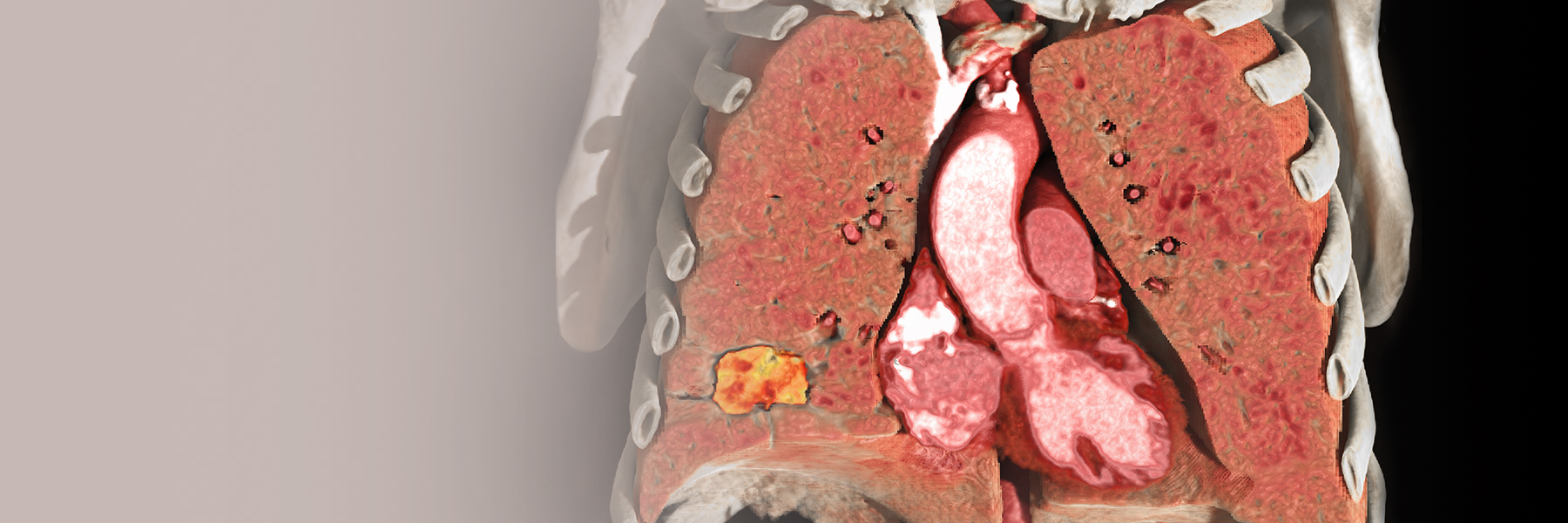 Thoracic Lung Imaging