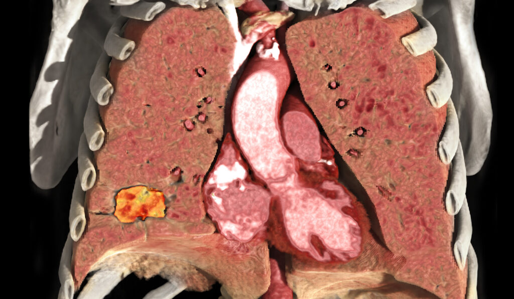 Thoracic Lung Imaging